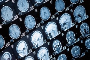 Head,And,Neck,Mri,Scan,,Anonymized,,Shallow,Focus,Depth